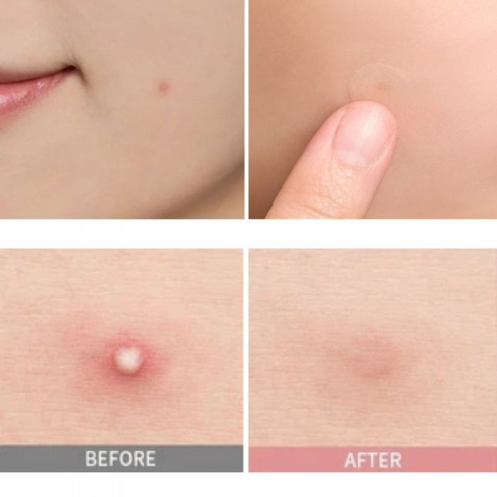 Точечные патчи от прыщей - Skin 1004 Spot Cover Patch фото 4