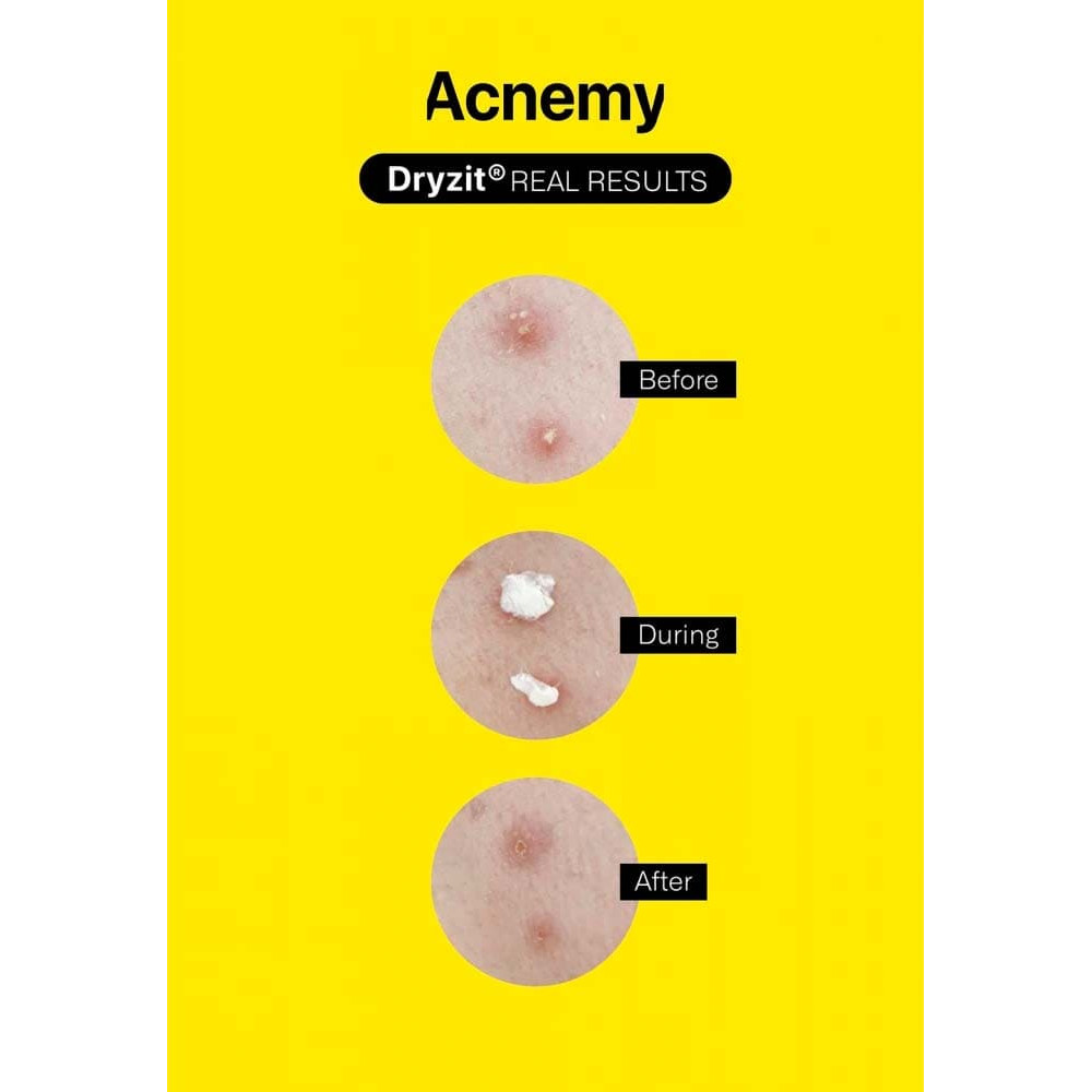 Подсушивающий лосьон - Acnemy Dryzit фото 2